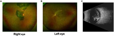 Case reports: Intraoperative migratory retinal venous thrombus in proliferative diabetic retinopathy